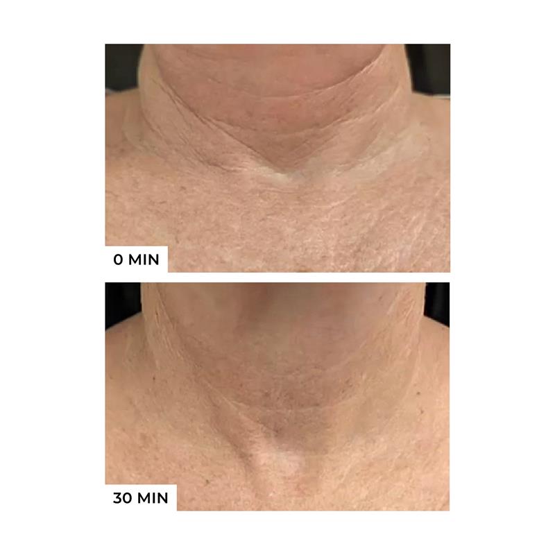 Load image into Gallery viewer, Freezeframe Neck Lift 50ml

