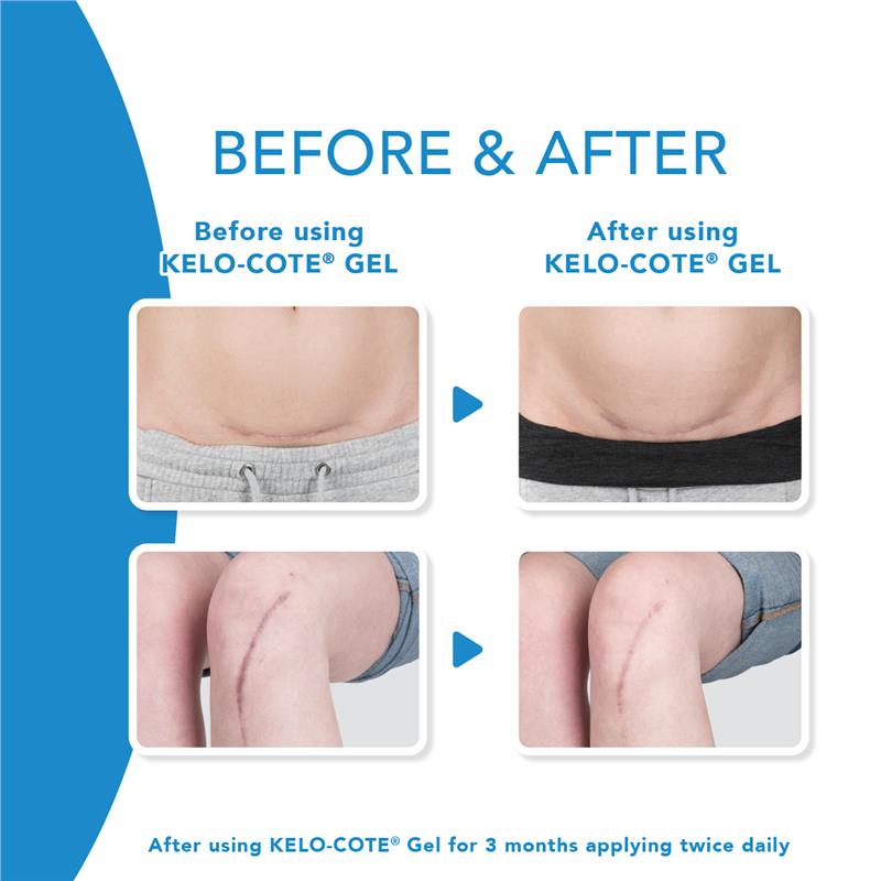 Load image into Gallery viewer, Kelo-Cote Scar Treatment Gel 15g
