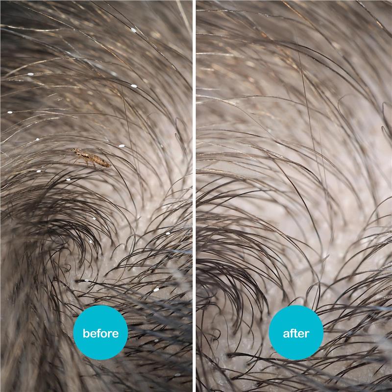 Load image into Gallery viewer, Nitwits Head Lice Comb Twin Pack

