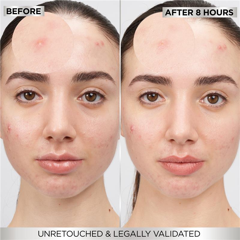 Load image into Gallery viewer, Garnier Pure Active Pimple Patch 44pk
