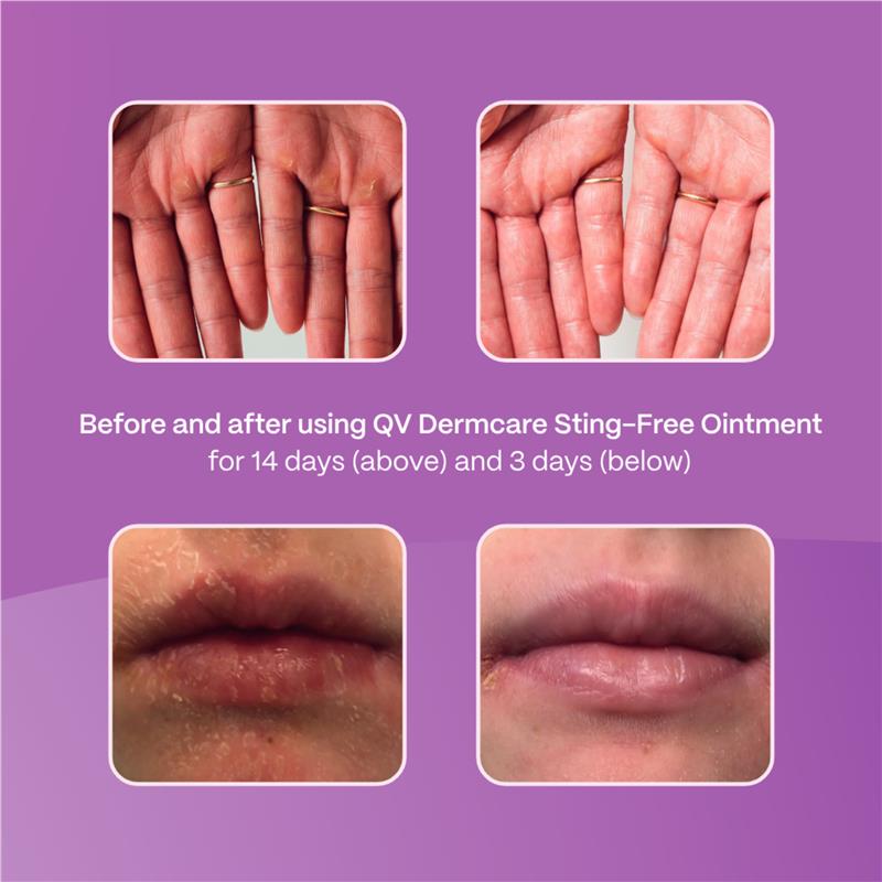 Load image into Gallery viewer, Ego QV Dermcare Stingfree Ointment 100g
