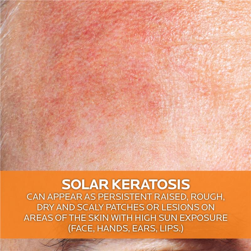 Load image into Gallery viewer, La Roche Posay Anthelios KA+ SPF50+ 50ml

