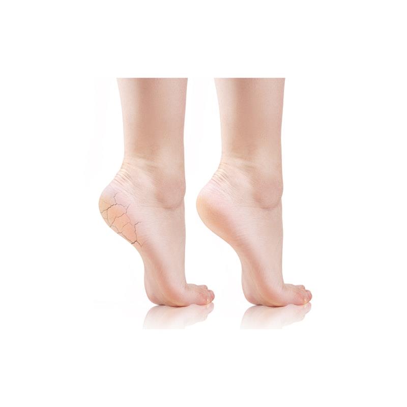 Load image into Gallery viewer, FeetCalm Cracked Heel Mousse 25% Urea 125ml
