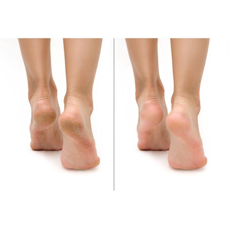 Load image into Gallery viewer, FeetCalm Callus &amp; Hard Skin Spray 20% Urea 125ml
