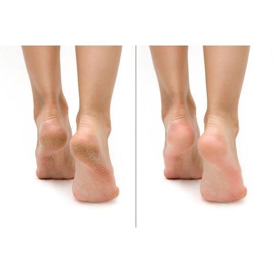 FeetCalm Callus & Hard Skin Spray 20% Urea 125ml