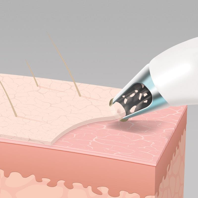 Load image into Gallery viewer, Radiance Microdermabrasion with Cooling 1Pack
