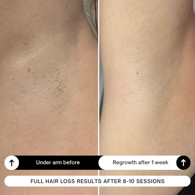 Load image into Gallery viewer, Happy Skin Co Diamond IPL Hair Removal Handset Black
