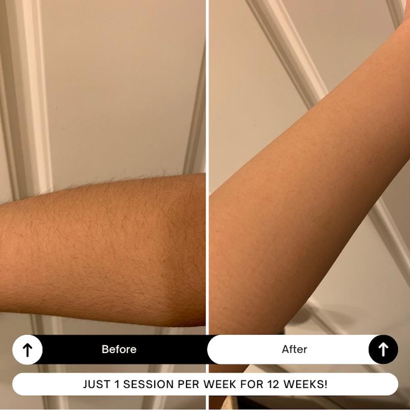 Load image into Gallery viewer, Happy Skin Co Gen.2 IPL Hair Removal Handset White
