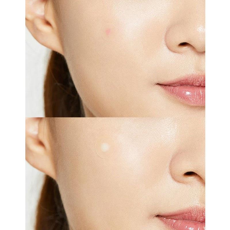 Load image into Gallery viewer, COSRX Acne Pimple Master Patch Bundle 5Pack
